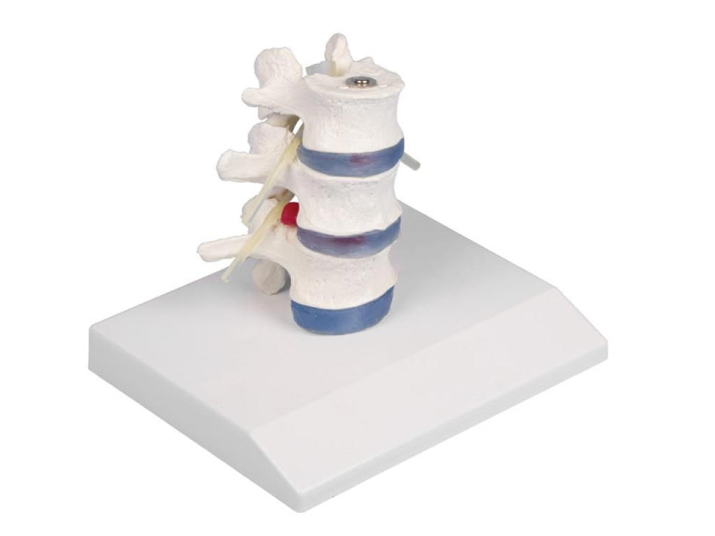 Ländkotor med diskbråck i mellankotskivorna - anatomisk bordsmodell